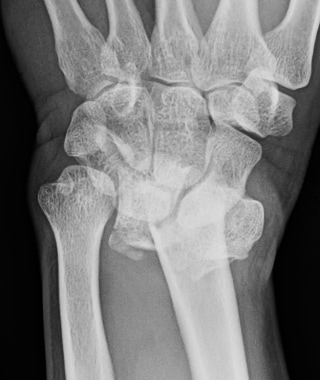 colles fracture xray