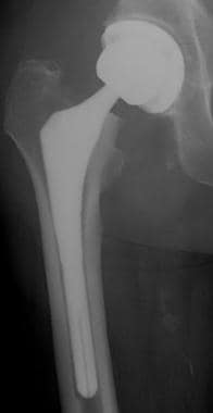 Significant subsidence of a femoral component 16 d