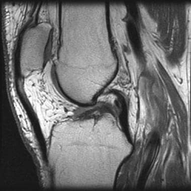 Chronic anterior cruciate ligament (ACL) tear. T1-
