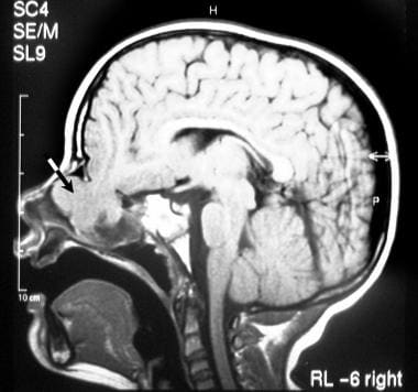 Sagittal, T1-weighted magnetic resonance imaging (