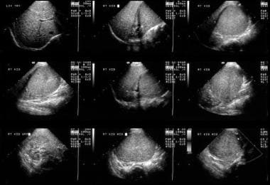 This 6-year-old male child with hematuria was refe