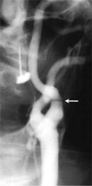 Anterior left common carotid arteriogram in a pati