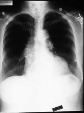 Chest radiograph in a patient with a thoracic aort