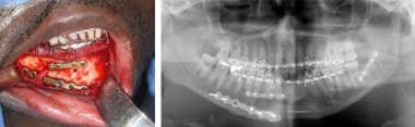 Bilateral fractured mandible treated by open reduc