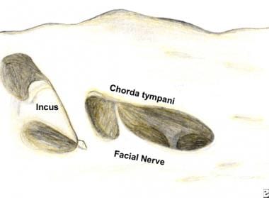Exposure of the facial nerve after a cortical mast