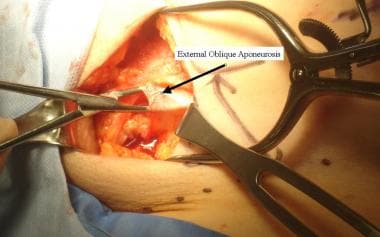 Open inguinal hernia repair. Division of external 