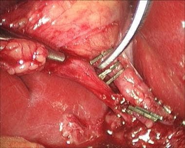 Laparoscopic cholecystectomy. Transection of cysti