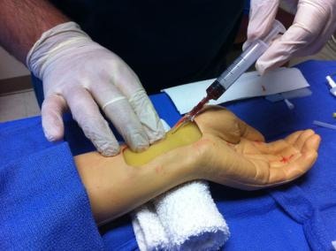 Radial artery cannulation (Seldinger). Puncture of