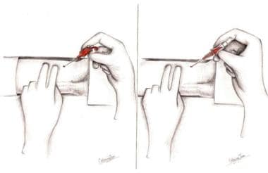 Radial artery sheath insertion. Puncture radial ar