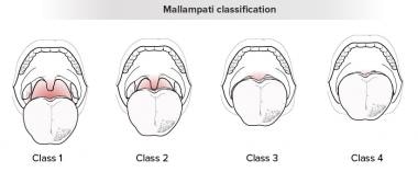 Mallampati classification. 