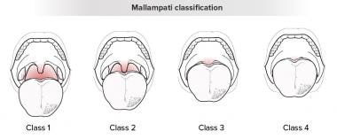 Mallampati分类。
