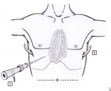 Operative diagram illustrating the pectus bar afte