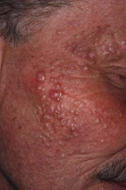 Numerous milia in a patient treated with vemurafen