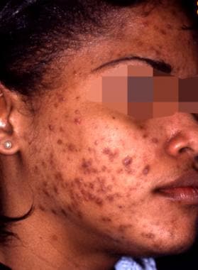 mild acne vulgaris