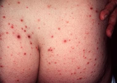 Pityriasis Lichenoides: Practice Essentials, Pathophysiology, Etiology