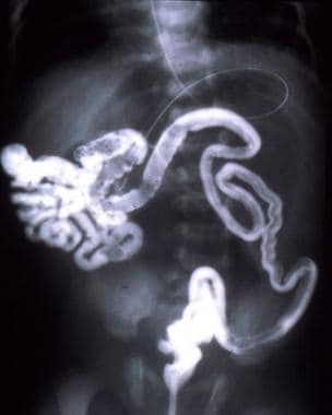Intestinal obstruction in the newborn. In babies w