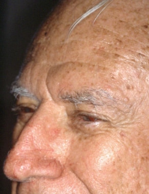 Three months postrepair of the left nasal tip. 