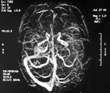 Cerebral Venous Thrombosis: Background, Etiology, Epidemiology