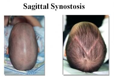 sagittal synostosis symptoms