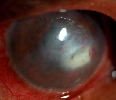 fungal corneal ulcer satellite lesion