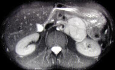 Axial, T2-weighted magnetic resonance imaging (MRI