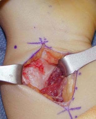 Intraoperative color photograph of Vickers ligamen