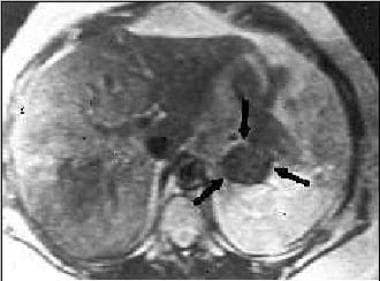 Magnetic resonance imaging (MRI) scan in a patient