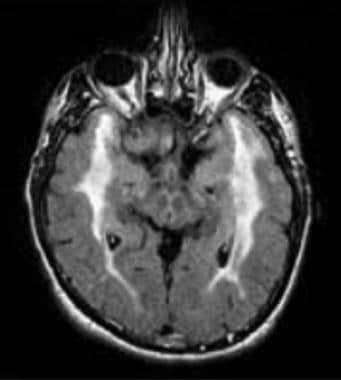 FLAIR MRI of the brain showing hyperintensities in