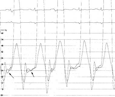 Constrictive Pericarditis. The simultaneous right 