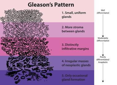 Prostate cancer. The standard approach for grading