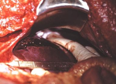 Penetrating abdominal trauma. Tangential gunshot w