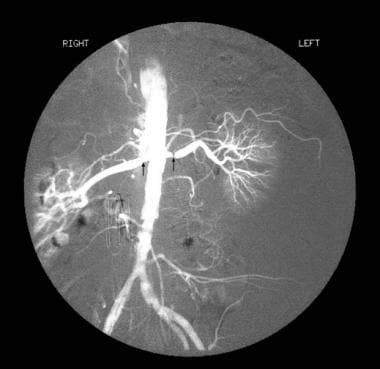Angiogram showing bilateral renal artery stenosis.