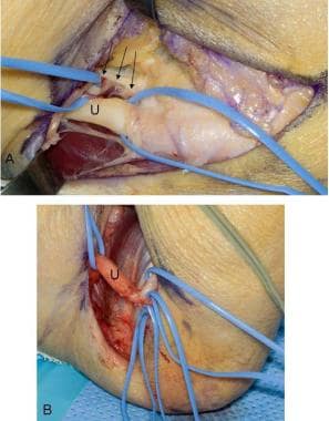 Pudendal Nerve Entrapment Syndrome: Clinical Aspects and Laparoscopic  Management