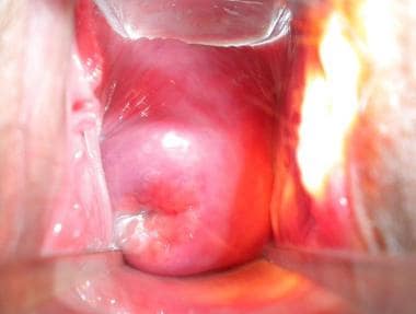 Cervix of a lactating woman without sexually trans