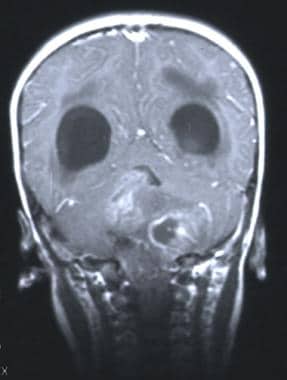 Coronal T1-weighted MRI with contrast demonstratin