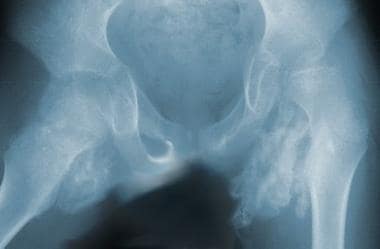 This radiograph clearly demonstrates fairly extens