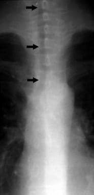 Tracheal stenosis on chest x-ray film. Courtesy of