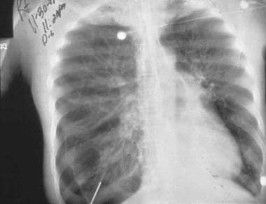 spontaneous pneumothorax tracheal deviation