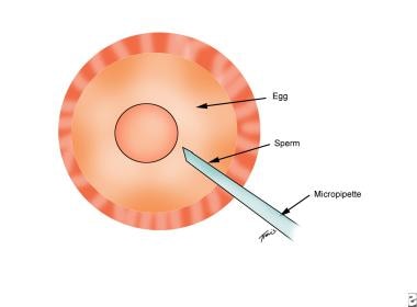 Male infertility. Technique of intracytoplasmic sp
