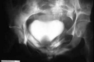 Cystogram of extraperitoneal bladder rupture. Note