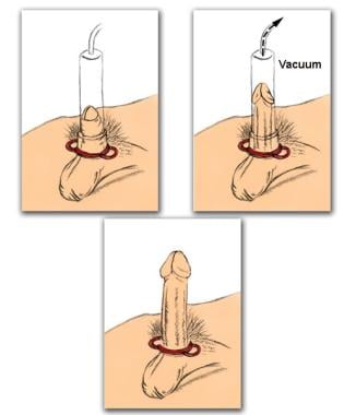 Long Dong (from an ad for penis enlargement pills) : r/BadMensAnatomy