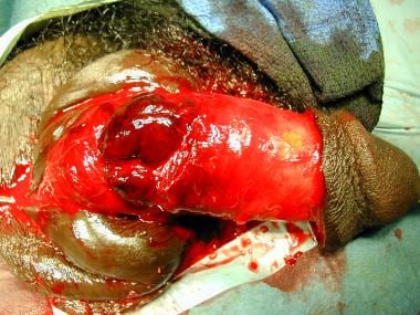 More severe penile fracture. 