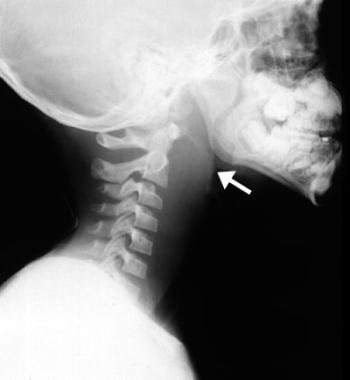 Lateral view X-ray showing the soft neck tissue and revealing widening