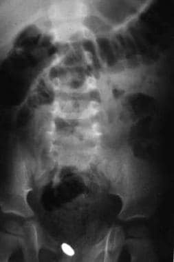 Radiograph of child 1 week after ingestion of a di