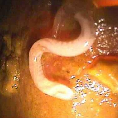 Hookworm infection - UF Health