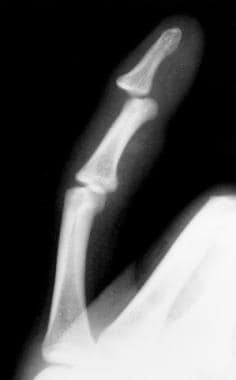 Oblique view of distal interphalangeal (DIP) joint