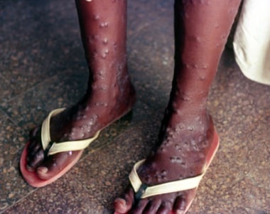 Ordinary form of variola minor strain of smallpox 