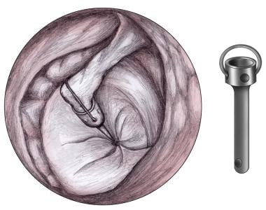 Stapedotomy Animation to Treat Otosclerosis (Curable Type of