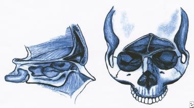 Anterior and lateral views of the frontal sinus. T