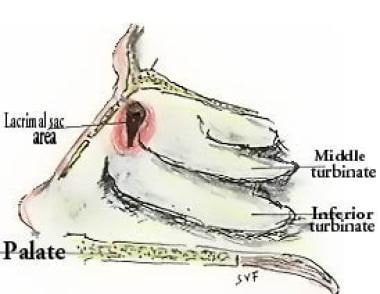 Schematic endoscopic view of the area of lacrimal 